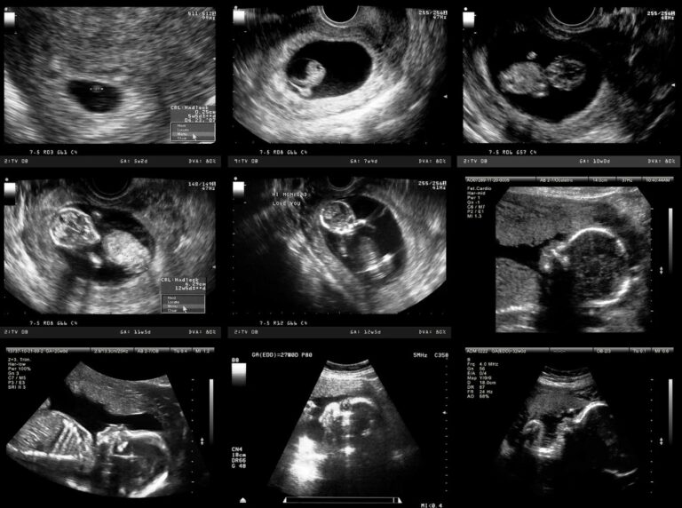 Ultrasounds-During-Pregnancy